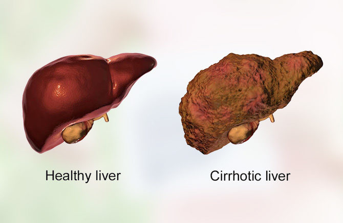 Cirrhosis-of-Liver