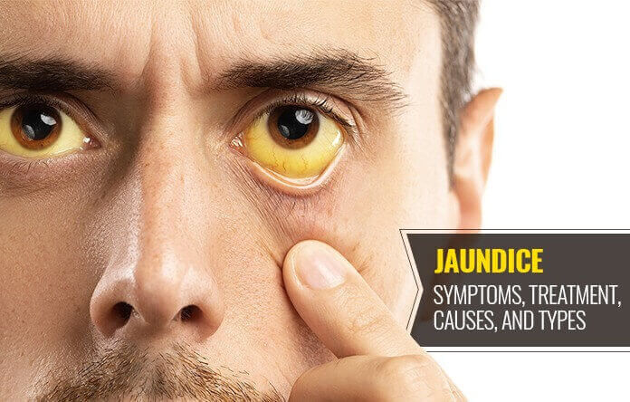 Jaundice Causes 