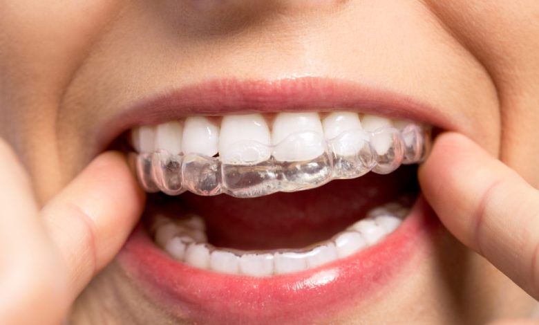 Invisalign Attachments