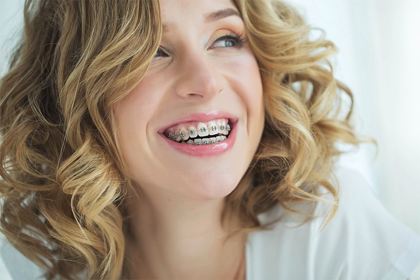 Braces Colors What s Available And How To Choose Reca Blog