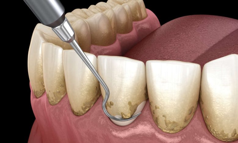 Tooth rot