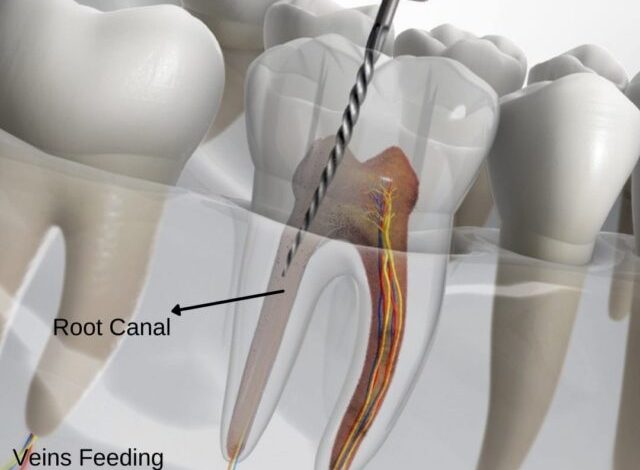 root canal therapy